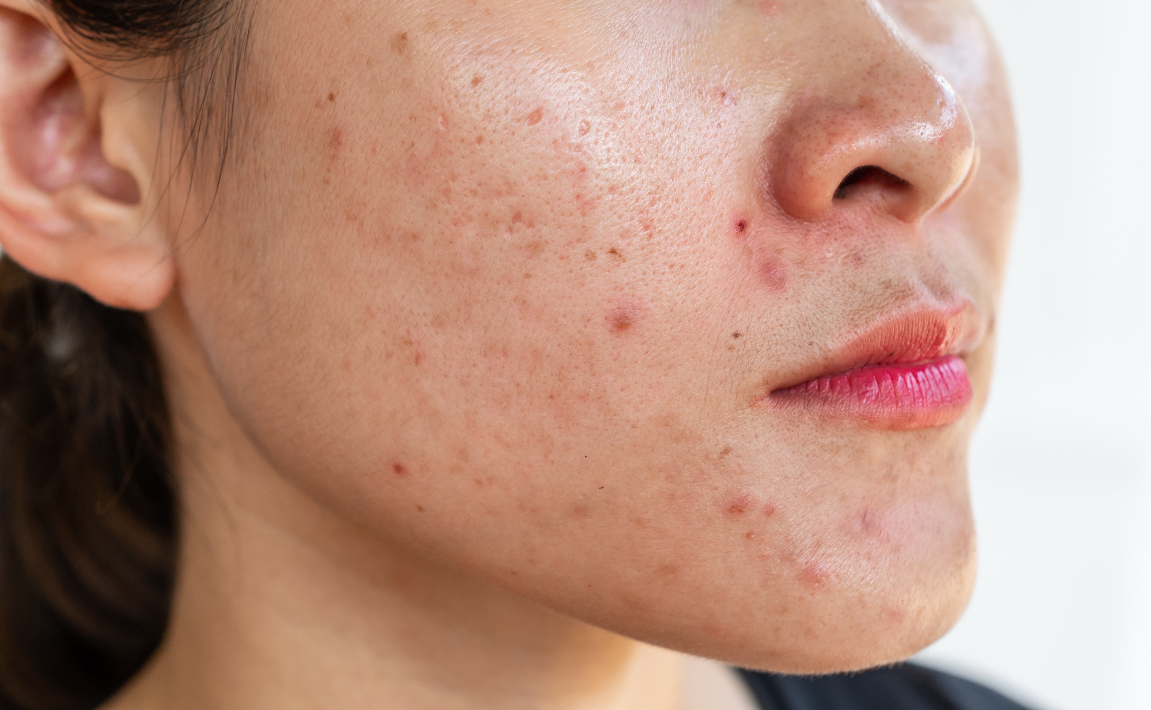 Modern Skin is Over-Stressed and Under-Nourished