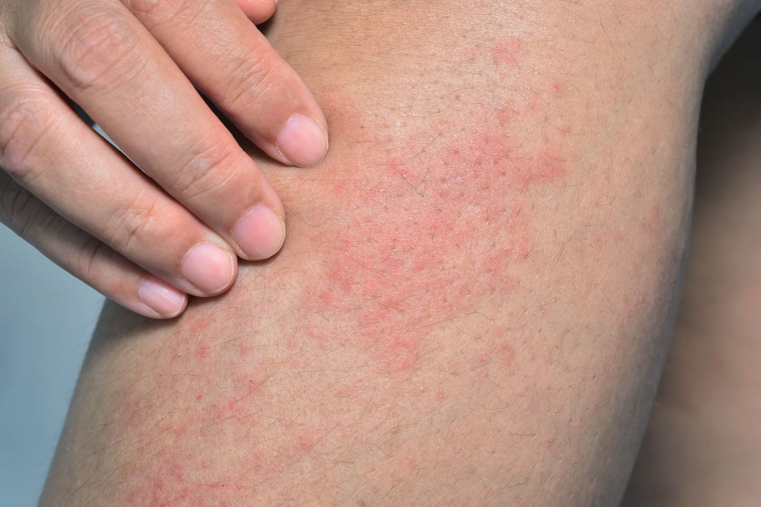 What causes prickly heat rash?