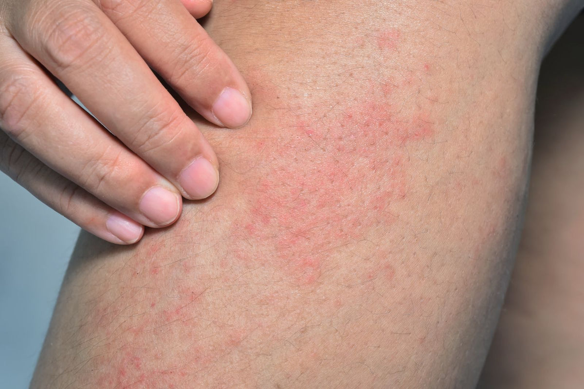 What causes prickly heat rash?