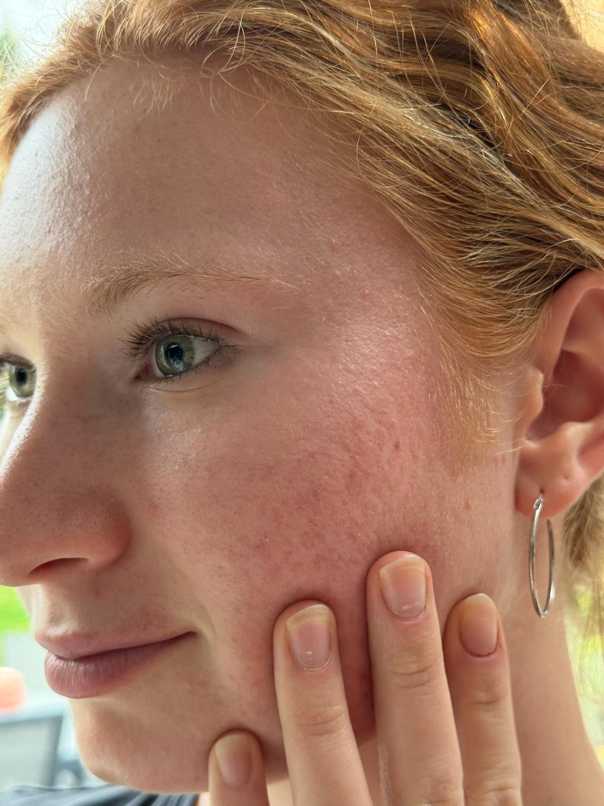Sensitive Skin in the UK: Why Less Really Can Be More