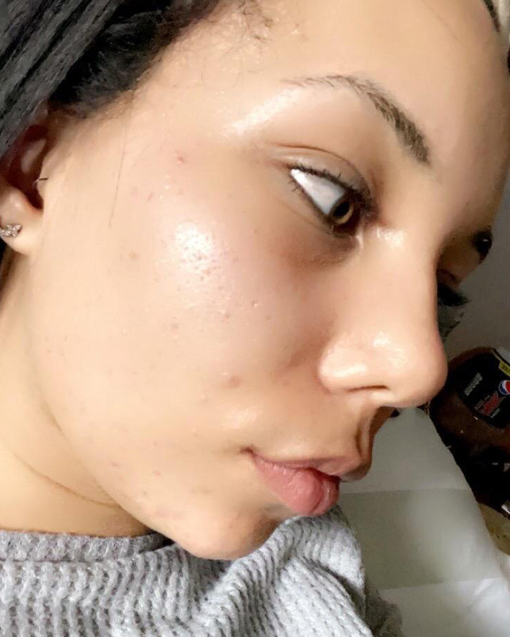 Close-up selfie of a person's face showing a glossy, dewy complexion with visible pores and blemishes.