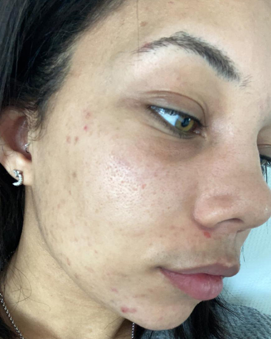 Close-up of a person's face showing skin texture, blemishes, and acne on the cheek and jawline.