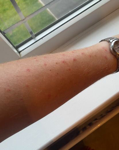 A close-up of a person's forearm resting on a white windowsill, showing small red rash spots. A silver-toned metal watch is visible on the wrist.