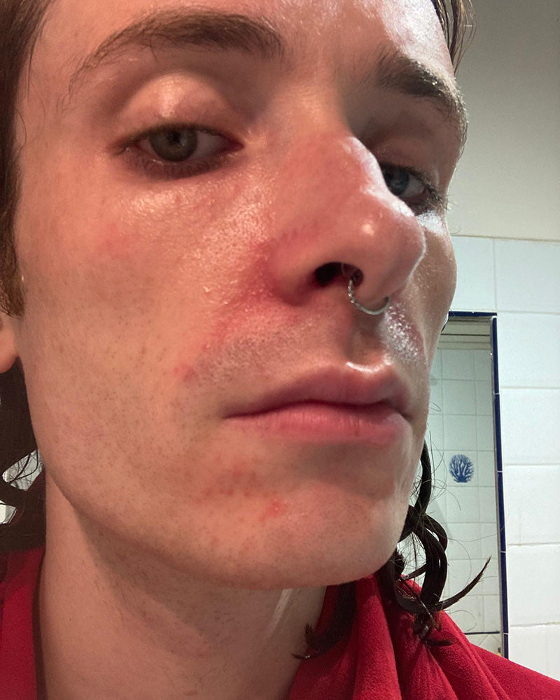 A close-up selfie of a person's face showing red, irritated skin on the nose, cheeks, and chin, with a silver nose ring. The person is wearing a red shirt, and a tiled bathroom wall is visible in the background.