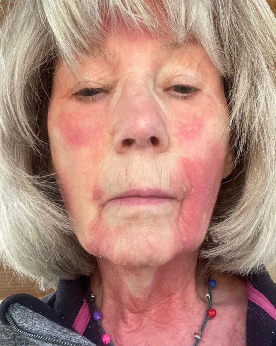 Close-up of an older woman with grey hair and visible redness across her face and neck.